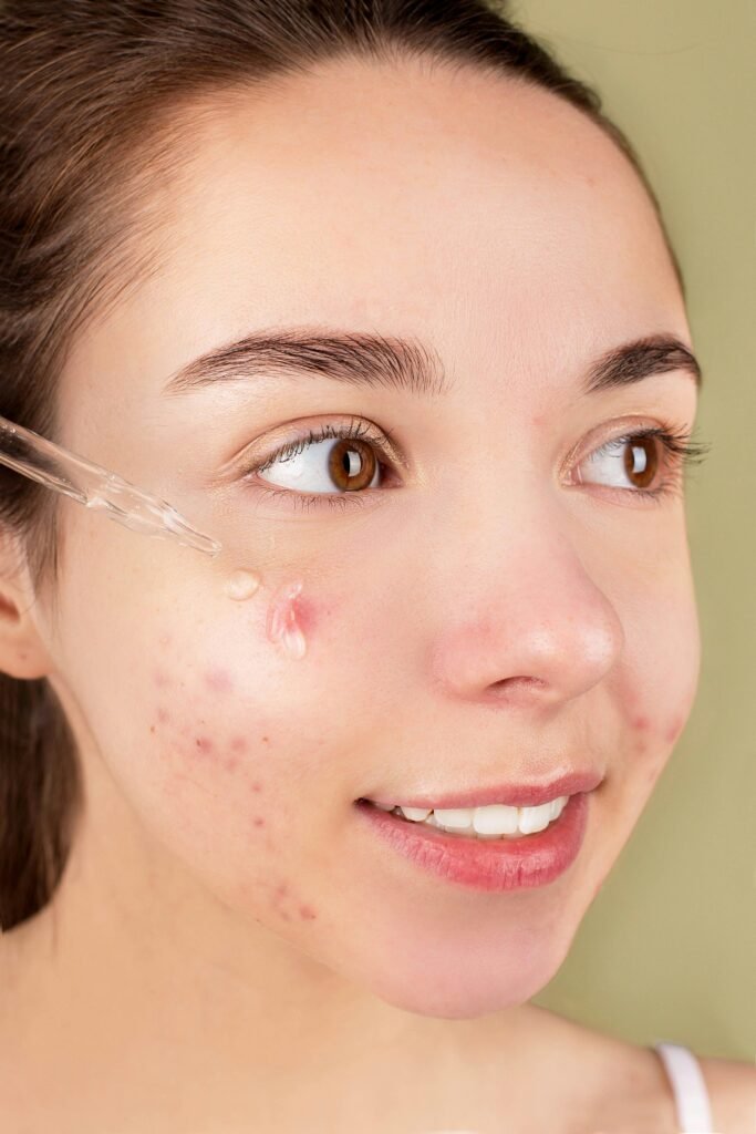 Young woman with acne breakouts on her face, showing a close-up of pimples and skin imperfections